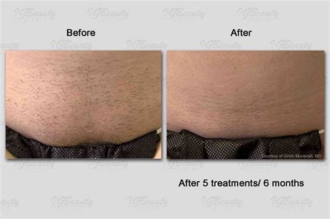 brazilian laser hair removal reviews